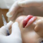 Lip flip or lip fillers 1500x1041