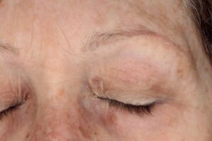 Wiqo treatment after 3 to 2